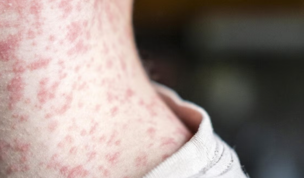 https://www.tricitylocalnews.com/wp-content/uploads/2025/03/measles-600x352.png